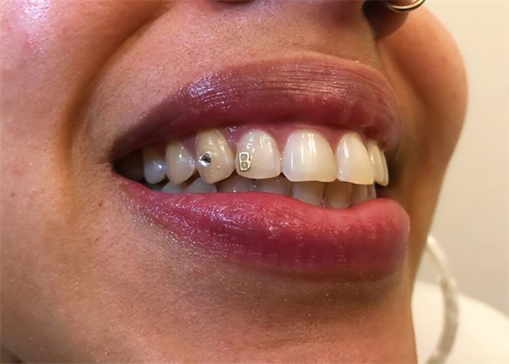 Close-up smile with dental jewel tooth gem