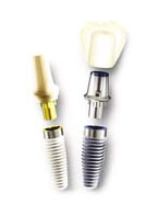 Benefits of Dental Implants at Agaram Dental Madurai