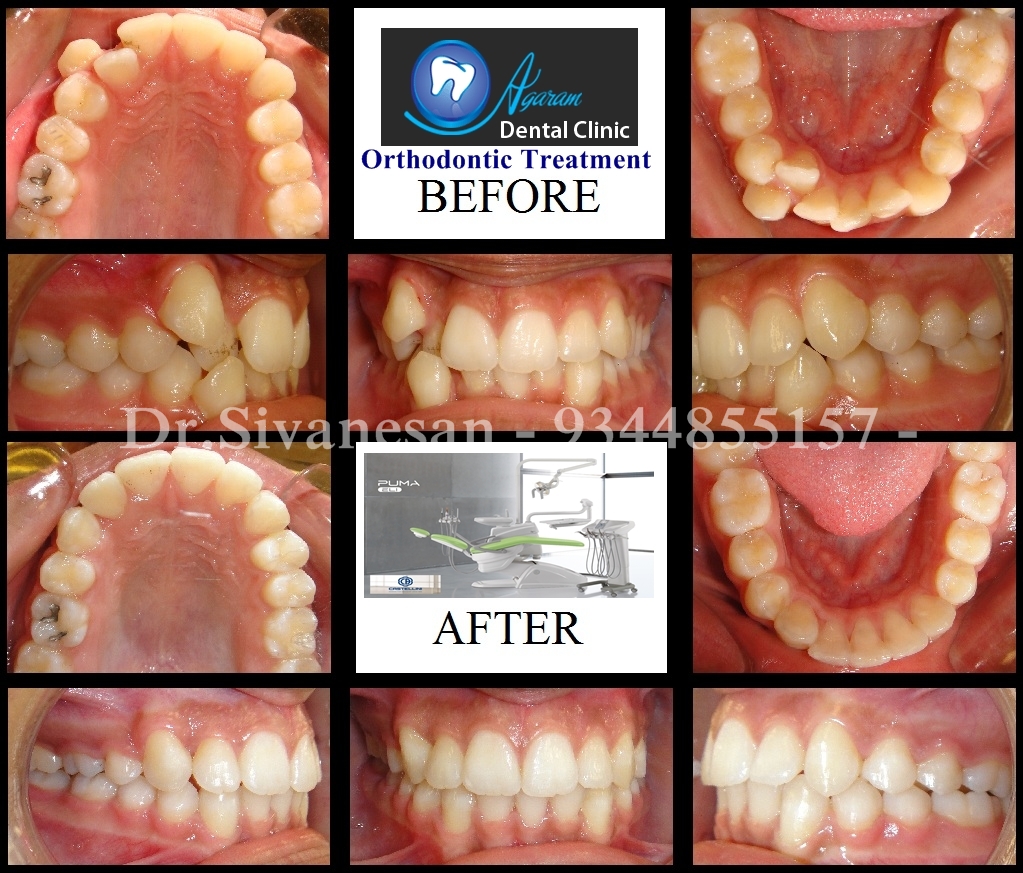 Orthodontics and Braces Madurai