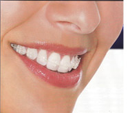 Orthodontic Braces Madurai