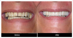 Diastema Gap Closure