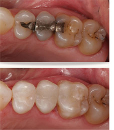 Composite Dental Filling